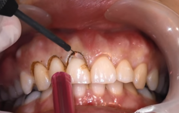 Операция гингивопластика в стоматологии в Москве