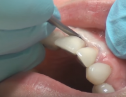 удаление имплантов зубов