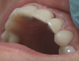 удаление импланты зубов