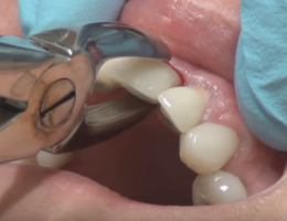 удаление зуба имплант