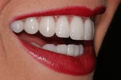 Керамические виниры на зубы
